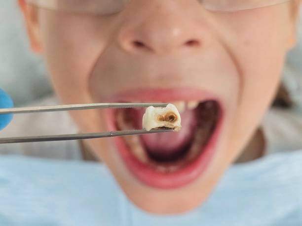 Best Emergency Treatment for Toothache in Rosenberg, TX