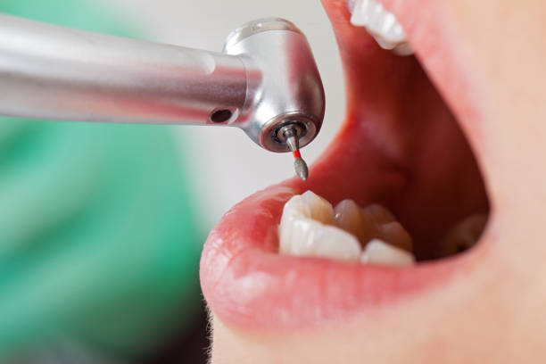 Best Emergency Tooth Extraction in Rosenberg, TX